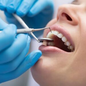 Scale and Polish (Teeth Cleaning)